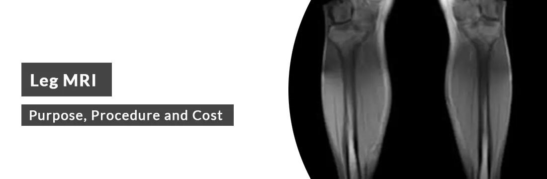 Leg MRI: Purpose, Procedure, Cost and Best MRI Centre in Delhi